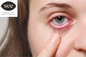 Dry Eyes vs. Eye Allergies: How to Tell the Difference