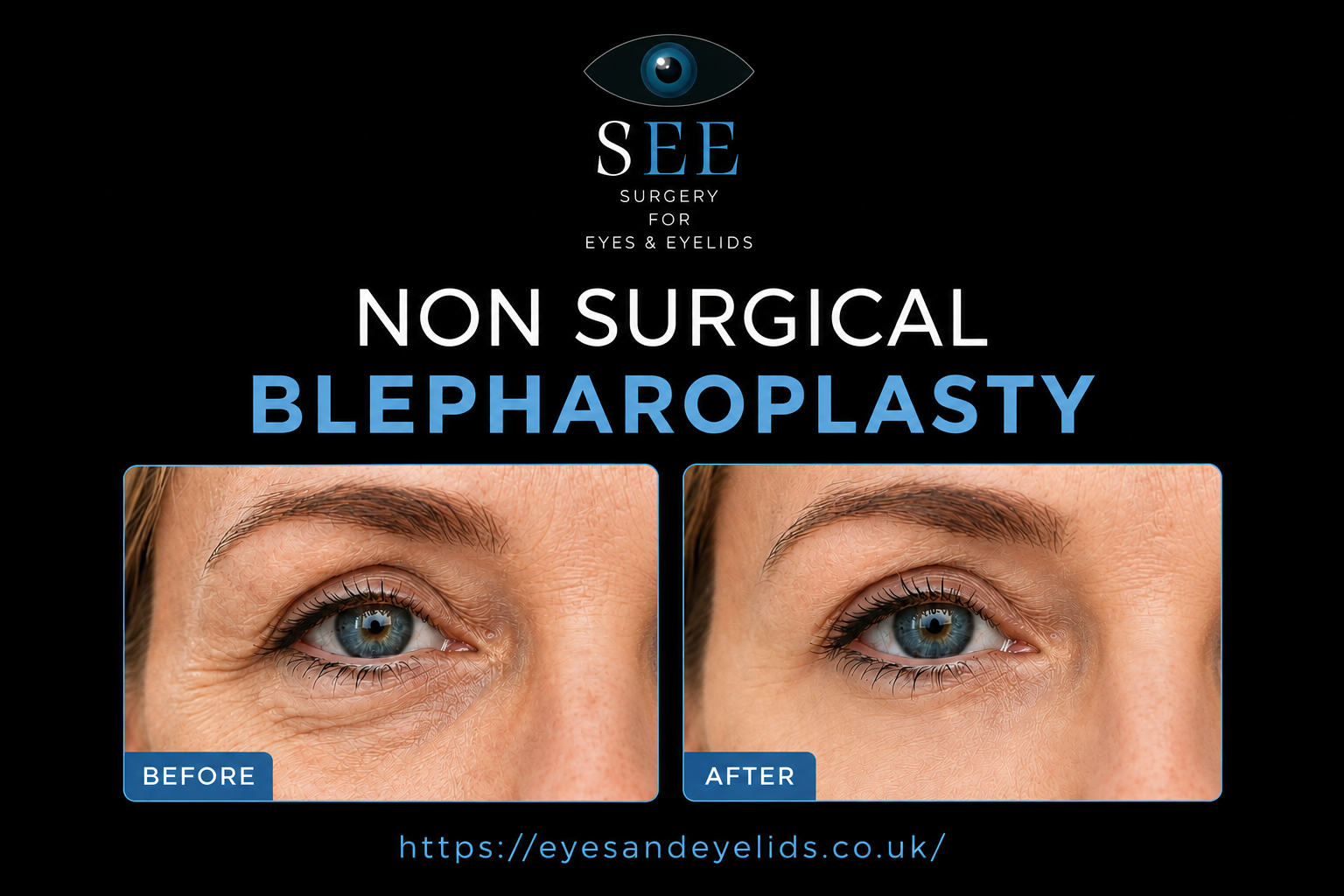 Non Surgical Blepharoplasty London in 2026