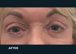 After – Case 14