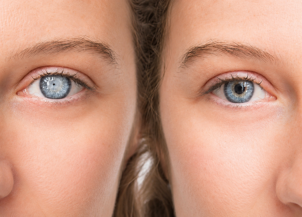 Cataract Treatment