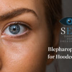 Blepharoplasty for Hooded Eyes