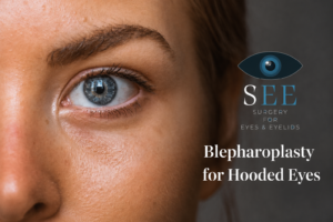 Blepharoplasty for Hooded Eyes: Treatment, Benefits and Results