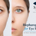 Blepharoplasty for Eye Bags