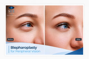 Can Blepharoplasty Improve Peripheral Vision and Eyelid Droop?