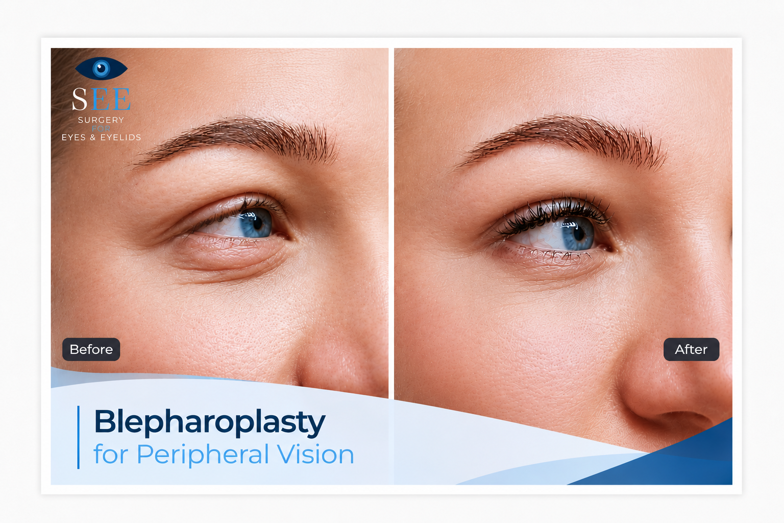 Drooping eyelids affecting vision