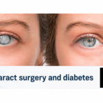Cataract Surgery