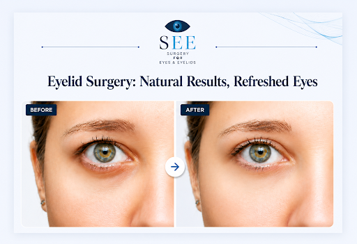 Blepharoplasty Surgery