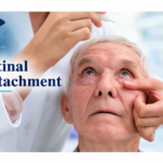 Retinal Detachment