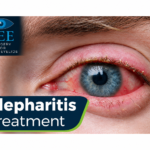 blepharitis treatment