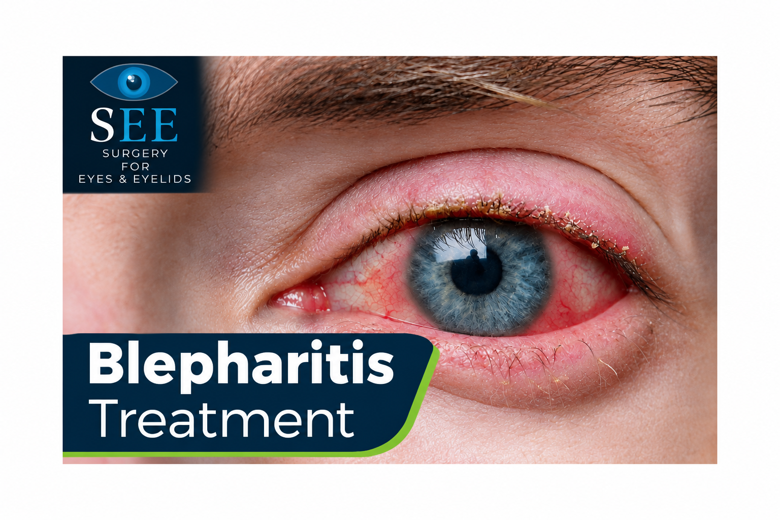 blepharitis treatment