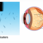 Eye Floaters