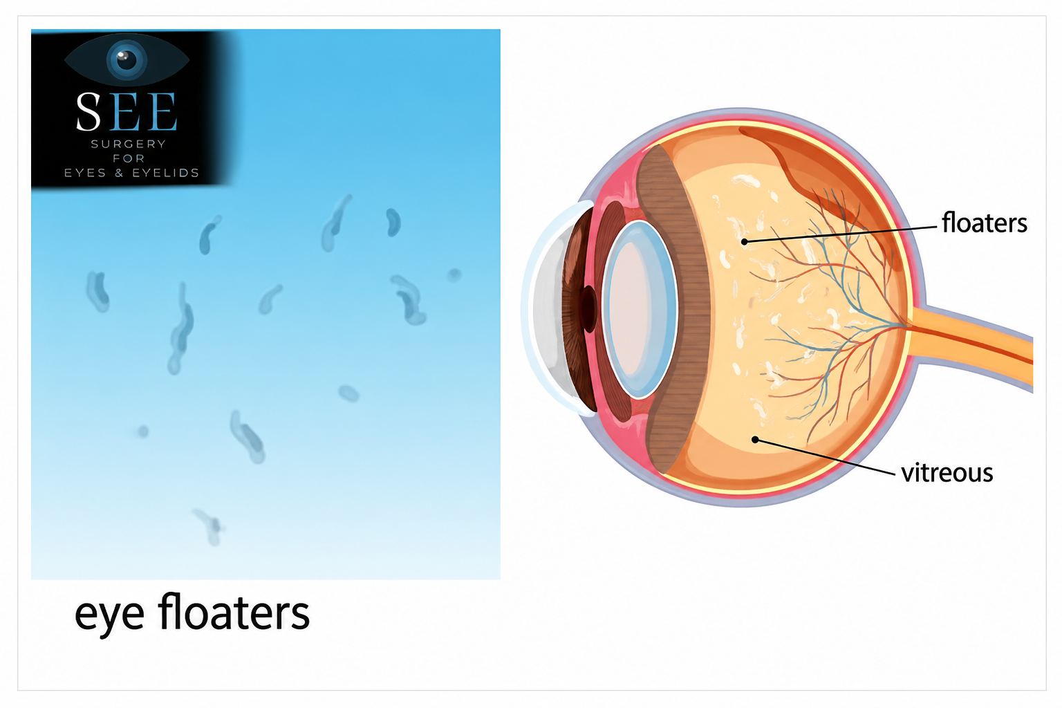 Eye Floaters
